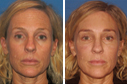 Before & After Photos